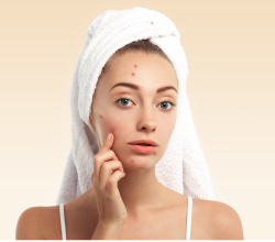10 Tips Para Mawala ang Pimples: Forum na Gabay para sa Mas Malinis na Balat