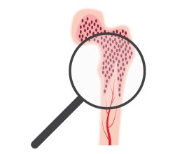 Bone Marrow Failure Syndrome Treatment in India for Zambian Patients