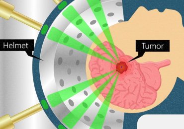 Low Cost Gamma Knife Radiosurgery in India