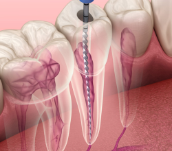 Agrawal Dental Clinic | Root Canal Treatment in Thane