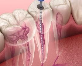 Agrawal Dental Clinic | Root Canal Treatment in Thane