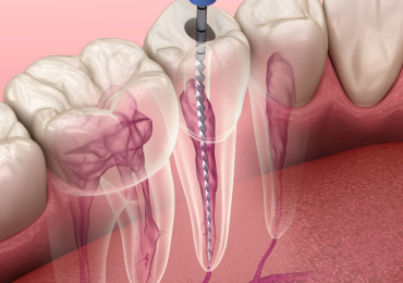 Agrawal Dental Clinic | Root Canal Treatment in Thane