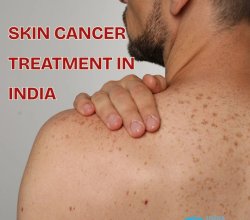 Skin Cancer Treatment in India