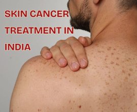 Skin Cancer Treatment in India
