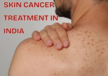 Skin Cancer Treatment in India