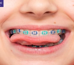 Full-Arch Reconstruction and the End of Removable Dentures