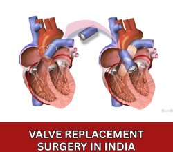 Valve Replacement Surgery Cost in India
