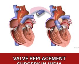 Valve Replacement Surgery Cost in India