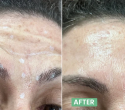 Botox in Bangalore – Safe & Natural Anti-Aging Solution