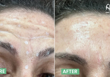 Botox in Bangalore – Safe & Natural Anti-Aging Solution