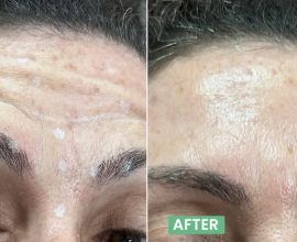 Best Botox in Bangalore – Is Anew Bangalore a Good Choice?