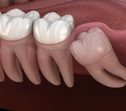 wisdom tooth removal singapore