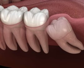 wisdom tooth removal singapore