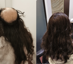 Hair Replacement Singapore