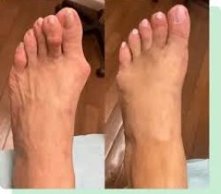 Foot Pain Plantar Fasciitis Elizabeth