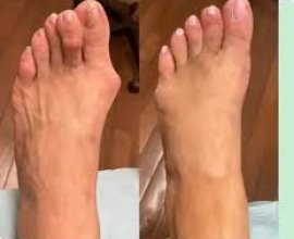 Foot Pain Plantar Fasciitis Elizabeth